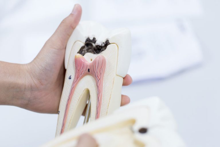 Dummy Model Of A Tooth Cavity