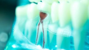 How Long Do Root Canals