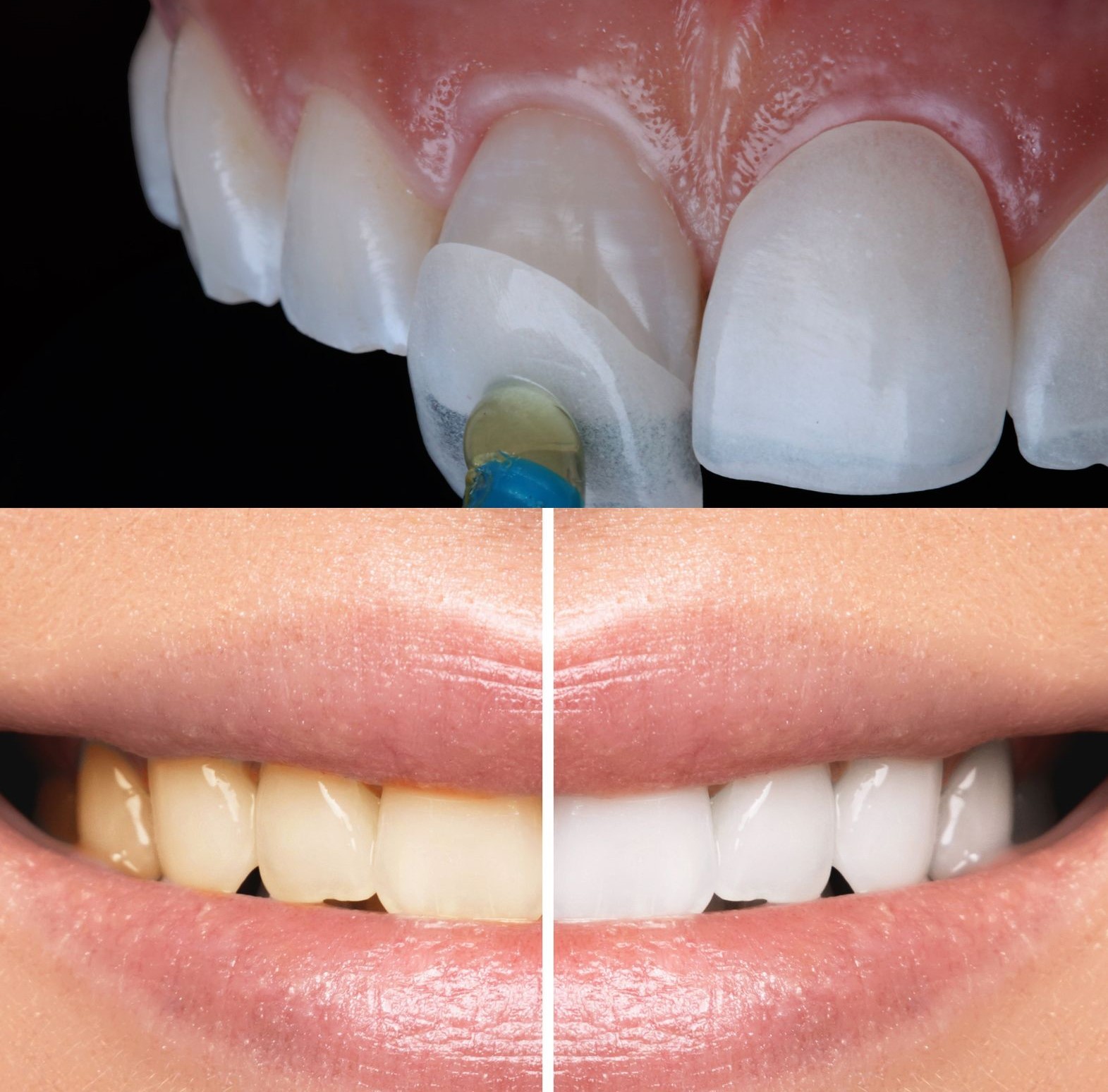 comparison on dental veneer vs teeth whitening treatment